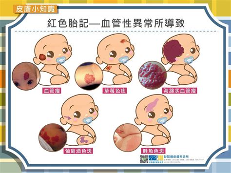 腳踝胎記|認識胎記的種類與治療照顧